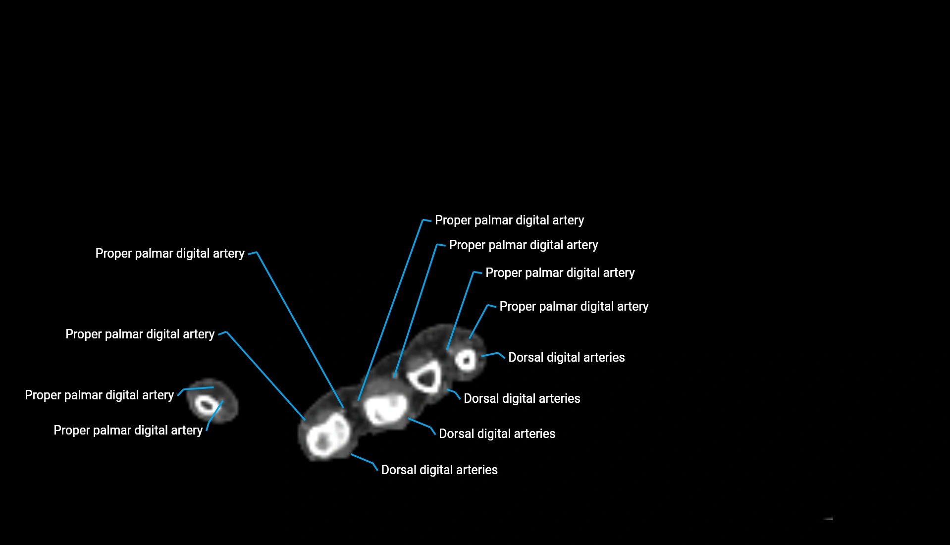 CTA upper limb axial cross sectional anatomy labelled image 42 (2).webp